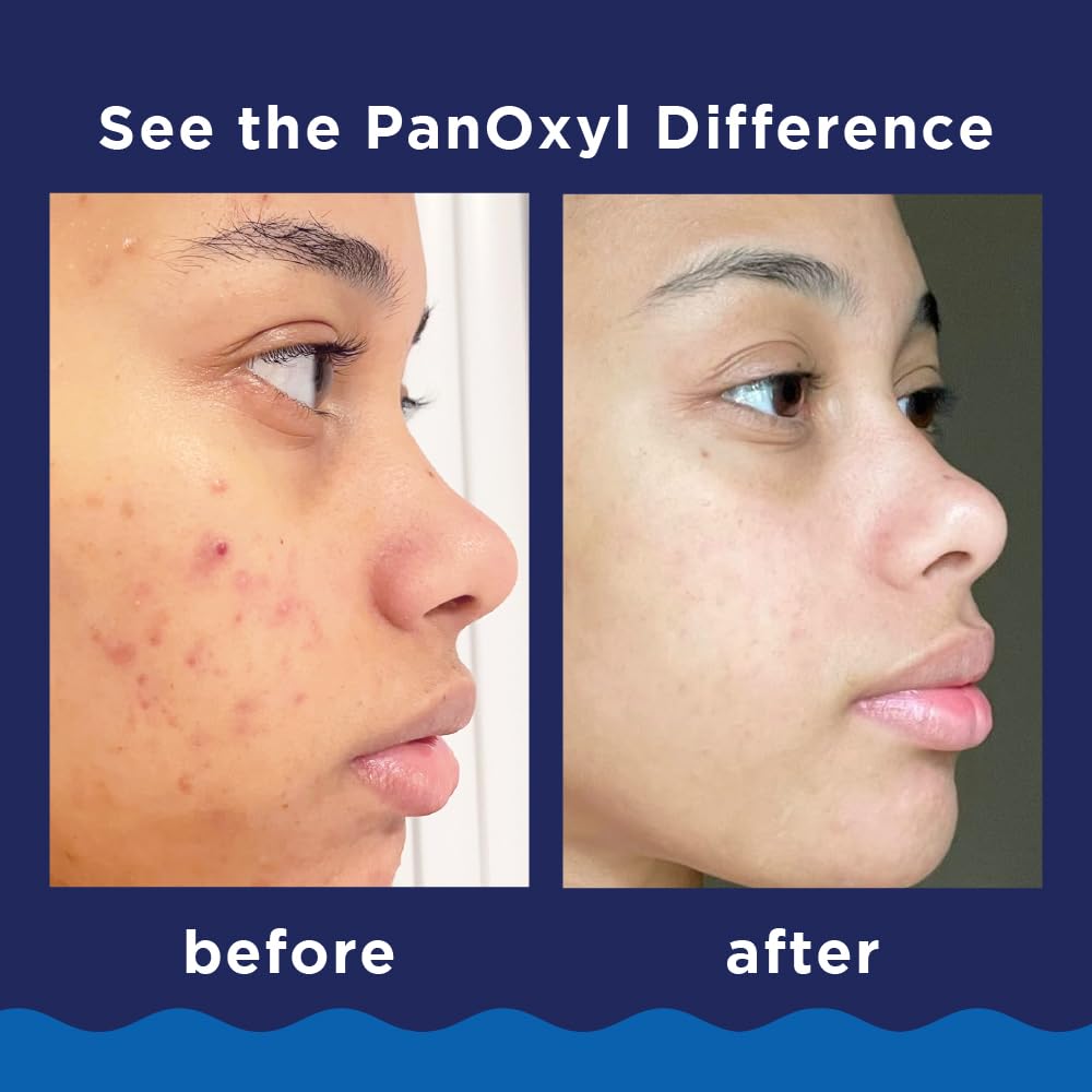 PanOxyl Acne Foaming Wash Benzoyl Peroxide 10% Maximum Strength Antimicrobial, 5.5 Oz